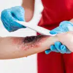 Burn Injury